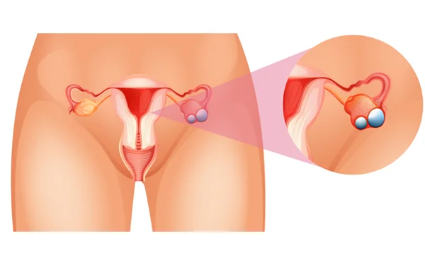 Ovarian Cyst Treatment