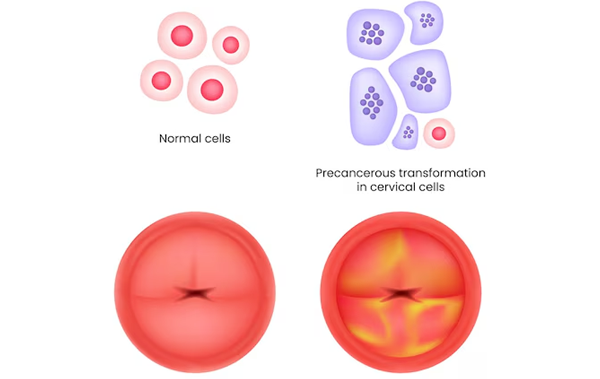 Early Diagnosis and Treatment of Pre Cancerous Cells on the Cervix