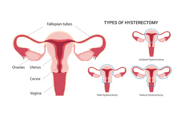 Abdominal Hysterectomy and Vaginal Hysterectomy or Removal of Uterus