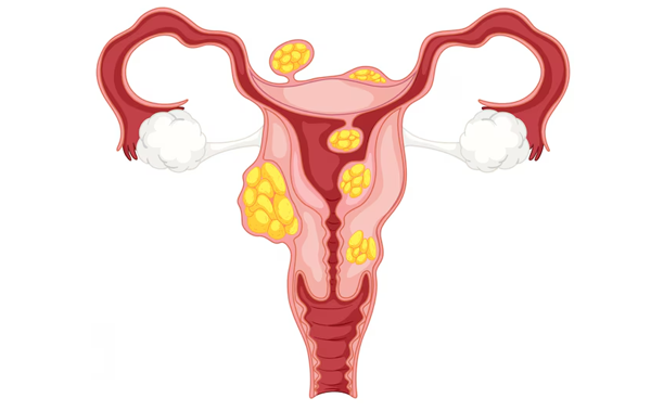 Myomectomy or Removal of Fibroids