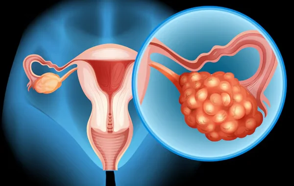 Cystectomy or Removal of Ovarian Cysts