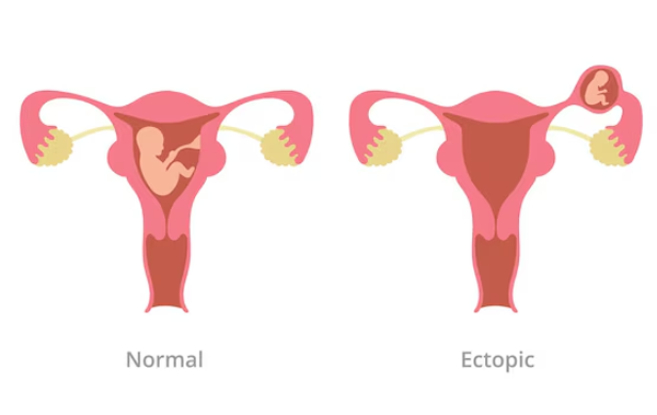 Management of Ectopic Pregnancy or Pregnancy Outside the Uterus