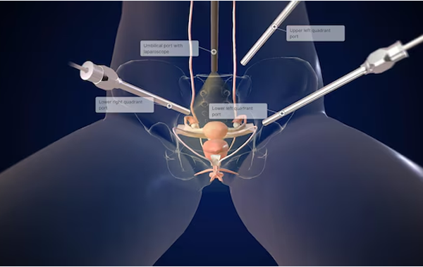 Total Laparoscopic Hysterectomy