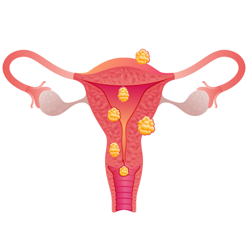 Fibroid Treatment